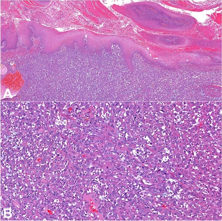 Photomicrographs of the tumor. A – Sarcomatous component adjacent to verrucous carcinoma (HE 100x); B – Sarcomatous component (HE 200x).