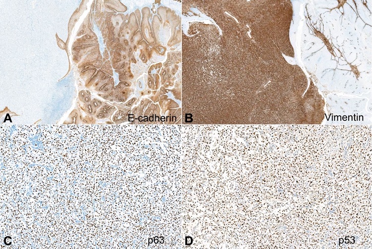 Photomicrographs of the tumor. A – Positive E-cadherin expression in the verrucous carcinoma component (right) and negative in the sarcomatous component (left) (100x); B – Positive vimentin expression in the sarcomatous component (100x); C – Positive p63 expression in the sarcomatous component (100x); D – Positive p53 expression in the sarcomatous component (100x).