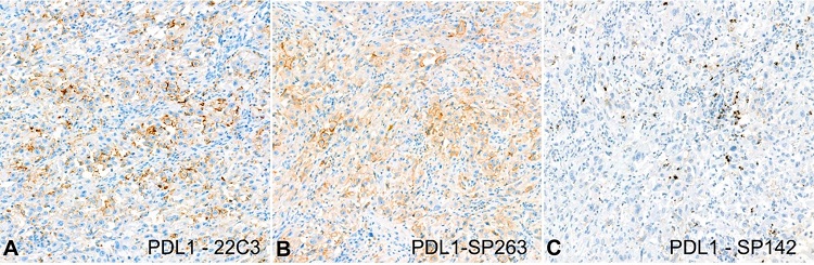 Photomicrographs of the tumor. PDL1 expression A – Positive expression for 22C3 (200x); B – Positive expression for SP263 (200x); C – Positive expression for SP142 (200x).