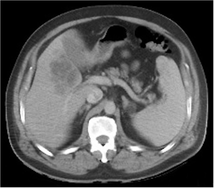 Abdominal computed tomography scan with intravenous contrast, portal phase, showing a hypodense and septated lesion in the hepatic segment V with peripheral enhancement.
