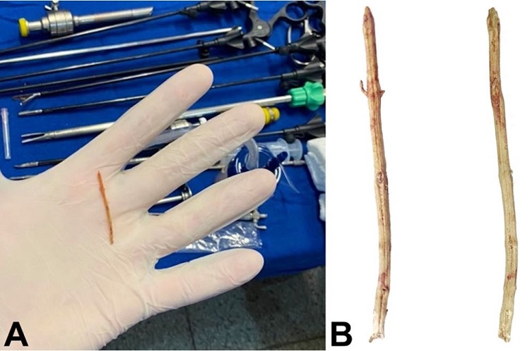 A –The intraoperative moment after laparoscopic removal of the foreign body; B – Frontal and lateral view of the foreign body (rosemary twig).