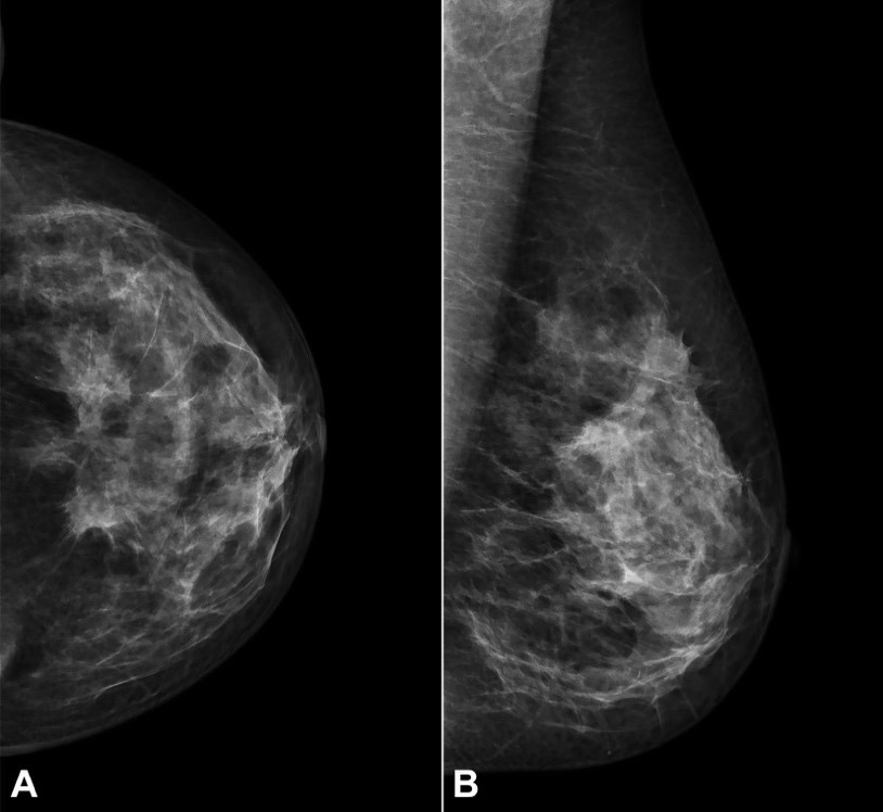 A &ndash; Mammography in craniocaudal; B &ndash; and mediolateral oblique views, showing partial response to palbociclib in association with letrozole plus goserelin.