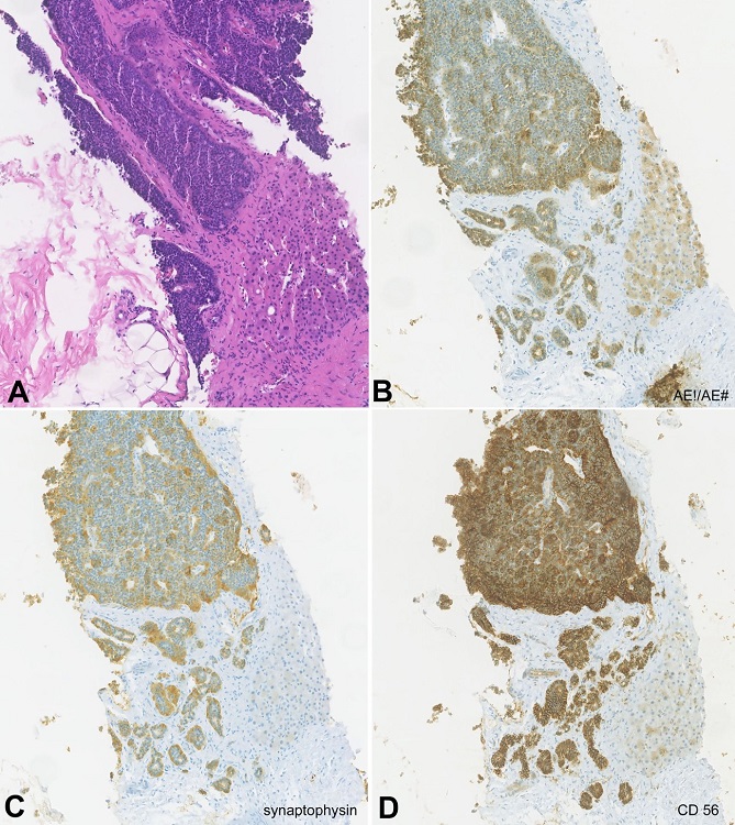 Photomicrographs of liver biopsy showing: A &ndash; hepatic parenchyma occupied by well-differentiated neuroendocrine tumor (H&E x100); immunohistochemistry analysis showing positivity for B &ndash; AE1 / AE3, a broad-spectrum cytokeratin positive in epithelial neoplasms (x100); C and D &ndash; positivity for synaptophysin and CD56, both neuroendocrine markers (x100).