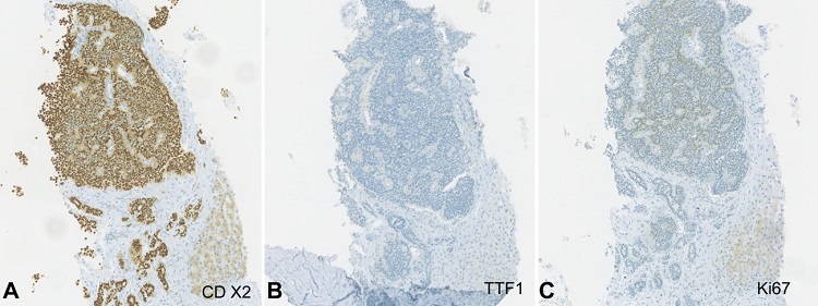 Photomicrographs of liver biopsy showing: A &ndash; positivity for CDX2, a specific marker of intestinal epithelial cells (x100); B &ndash; negativity for TTF1, a marker typically negative in extrapulmonary neuroendocrine tumors (x100); C &ndash; Less than 1% of the tumor cell population was positive for Ki67 expression (x100).