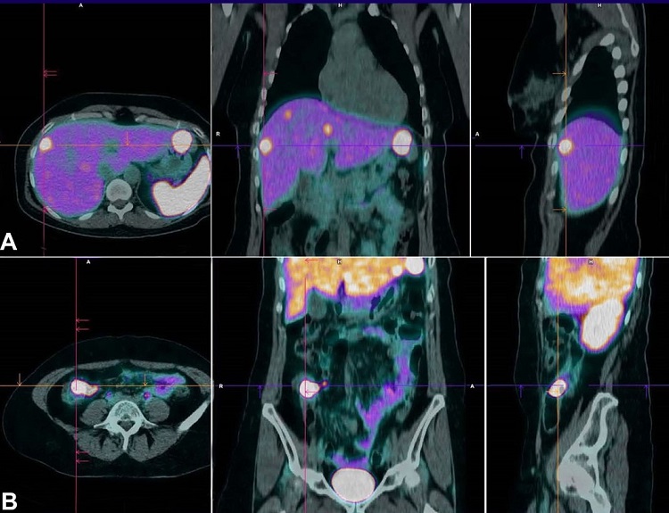PET 68Ga-DOTANOC showing A &ndash; liver metastases; and B &ndash; a primary tumor in the ileocecal topography with high expression of somatostatin receptors.
