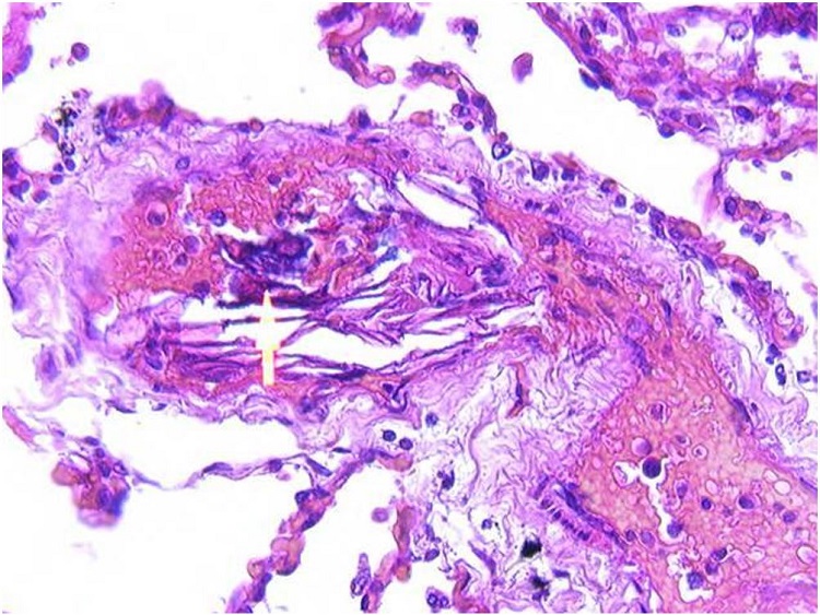 Microscopic examination revealed small calcifications (indicated by the arrow) in addition to flat squamous cells in the lumens of small pulmonary blood vessels (H&E, 100X).