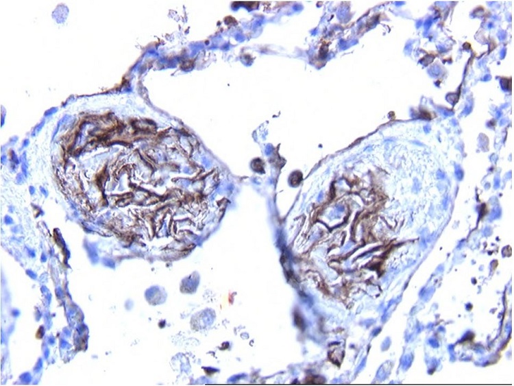 Immunohistochemical staining for cytokeratin AE3 confirmed the epithelial nature of the flattened squamous cells in the small pulmonary blood vessels (100X). 