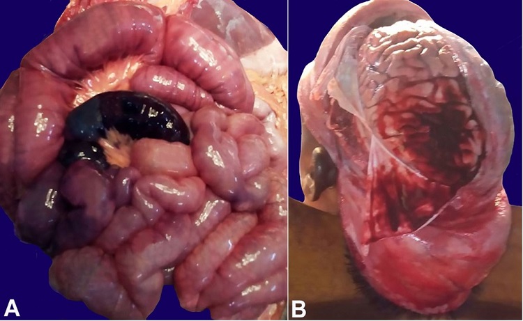 A &ndash; Gross picture of the small intestines showing marked congestion and a gangrenous segment; B &ndash; Large left subdural hemorrhage in left temporoparietal area.
