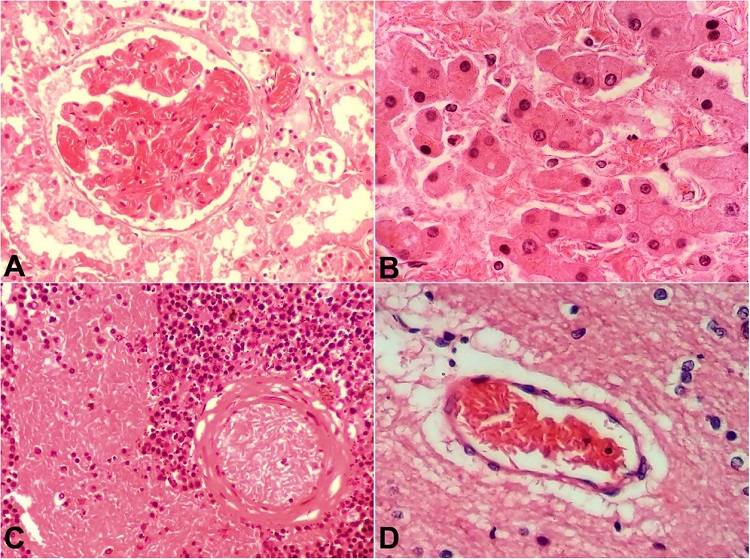 Photomicrographs of: A &ndash; kidney showing sickled red blood cells clogging glomerular capillaries (H&E, 400x); B &ndash; Liver showing hepatic sinusoids congested with sickled red cells and disarrangement of hepatic trabeculae. (H&E, 400x); C &ndash; spleen showing microvascular occlusion within the capillaries and congestion of red pulp by sickled red cells (H&E, 400x); D &ndash; Cerebral capillaries showing sickled red cells with perivascular space enlargement. (H&E, 400x).