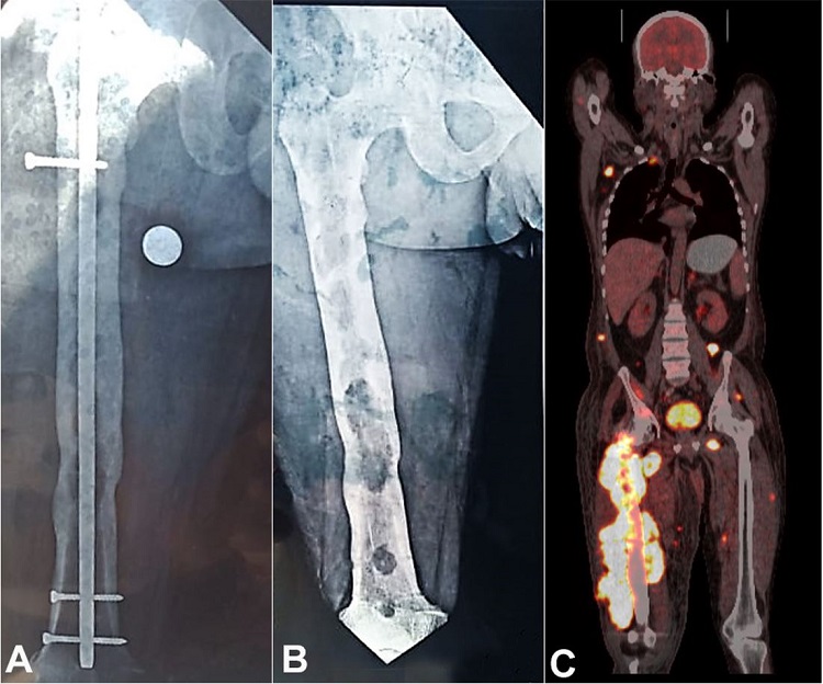 A and B – Antero-posterior and lateral plain radiographic view of the right lower extremity showing a femur with and without metallic rod and fixation screws. The ill-defined, expansile, intramedullary lytic lesions are seen involving metaphyseal and diaphyseal regions. C – Coronal fused PET/CT showing increased FDG uptake as the large skeletal lesion involving right femur and few enlarged lymph nodes along with subcutaneous and intramuscular deposits.