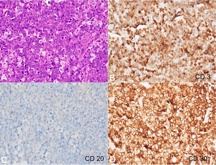 Photomicrographs of the biopsy. A – Large, atypical cells seen in solid sheets showing nuclear indentation, vesicular chromatin, prominent nucleoli and moderate basophilic to eosinophilic cytoplasm (H&E; x200); B – CD3 immunostain showing membranous positivity of variable intensity (x200); C – CD20 immunostain is negative (x200), D - CD30 displays strong membranous and golgi complex immunoreactivity (x200).