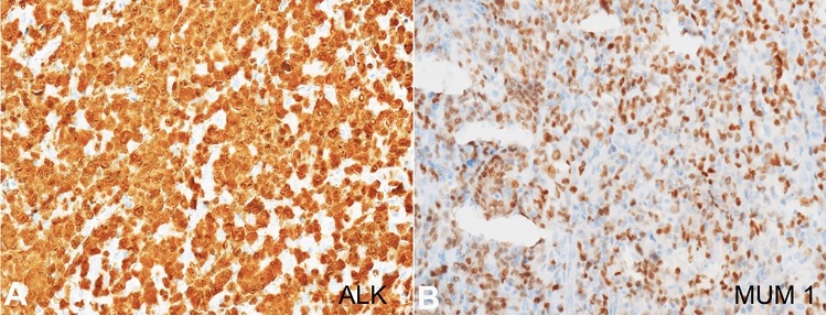 Photomicrographs of the biopsy. A – ALK immunostain showing diffuse positivity in both nuclear and cytoplasm (x200); B – MUM1 showing nuclear positivity (x200).
