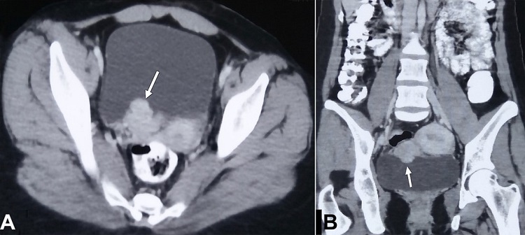 A – Axial; and B – Coronal contrast enhanced CT abdomen reveal nodular, polypoidal enhancing mass (white arrow) arising from right posterior wall of urinary bladder.