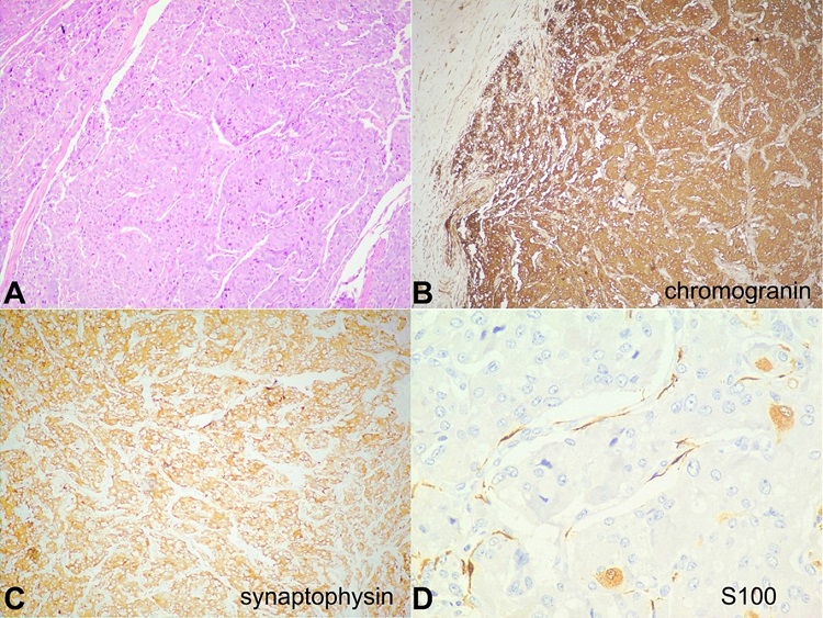A – Photomicrograph showing a tumor arranged in nests and trabeculae separated by thin fibrovascular septae, with ‘Zellballen pattern’ (H&E 100X); B – On IHC, the tumor cells are positive for chromogranin (100X); and C – synaptophysin (100X); D – S100 protein is expressed by sustentacular cells at the periphery of the cell nests (400X).