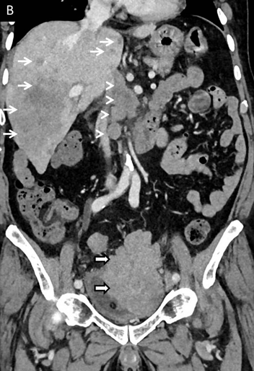 B – Coronal contrast-enhanced CT images arterial phase showing lobulated enhancing bladder mass (thick arrows), venous phase CT images showing paravesical extension (black arrows) with bulky retroperitoneal and abdominal lymphadenopathy (arrowheads) and multiple liver metastases (white arrows).