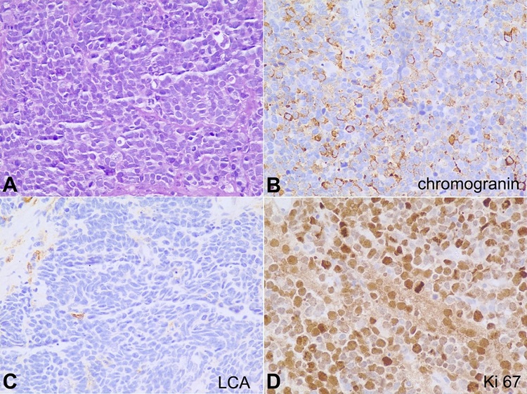 A – Photomicrograph showing a tumor with cells having high nuclear-cytoplasmic ratio and hyperchromatic nuclei arranged in diffuse sheets, H&E 400X; B – The tumor cells show partial cytoplasmic granular positivity for chromogranin, 400X; C – The tumor cells are negative for LCA, 400X; D – The Ki-67 proliferation index of the tumor is very high, 99% (400X).
