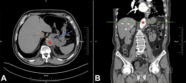 Thoracoabdominal CT scan: A &ndash; red asterisk indicates the abdominal aortic aneurysm, yellow arrows indicate the calcium aggregated in the atherosclerotic plaque, blue arrow points toward the duodenal lumen and the duodenal wall adjacent to the aneurysm; B &ndash; red asterisk indicates the lumen of the aneurysm, the green line indicates the level of section A of the figure. CT: computer tomography.