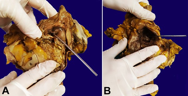 PADF post-fixation on formalin: A &ndash; duodenal side of the fistula (probe placed in the orifice); B &ndash; aortic side of the fistula (probe placed in the orifice).