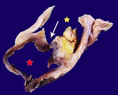 PADF post-fixation on formalin: section through the level of the fistula, the &ldquo;red star&rdquo; indicates the lumen of the aortic aneurysm, the &ldquo;yellow star&rdquo; indicates the duodenal lumen, white arrow indicates the place of the communication.