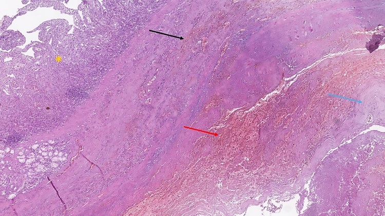 Histopathology from the area of penetration of the PADF; yellow asterisk indicates the preserved duodenal mucosa, black arrow indicates hemorrhages in the muscular layer of the duodenum, the red arrow indicates the area of penetration with diffuse hemorrhagic zones, blue arrow indicates the remnants of the aortic wall; hematoxylin and eosin stain, original magnification 40x.