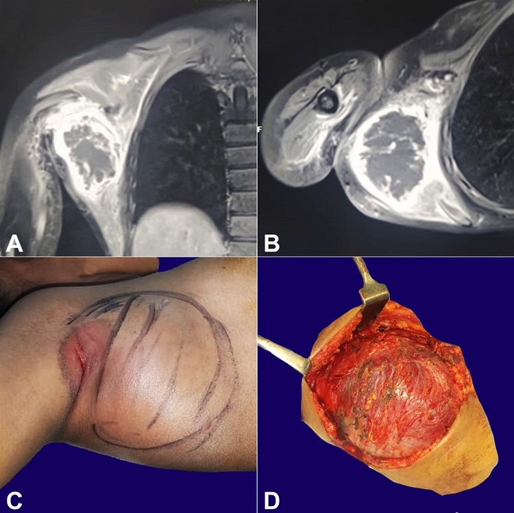 A and B &ndash; computed tomography of the shoulder; A &ndash; coronal plane; and B &shy;&ndash; axilla plane, image delineating the lesion with curvilinear peripheral ossification and central lucency; C and D &ndash; Pre-operative and intra-operative images of the lesion.