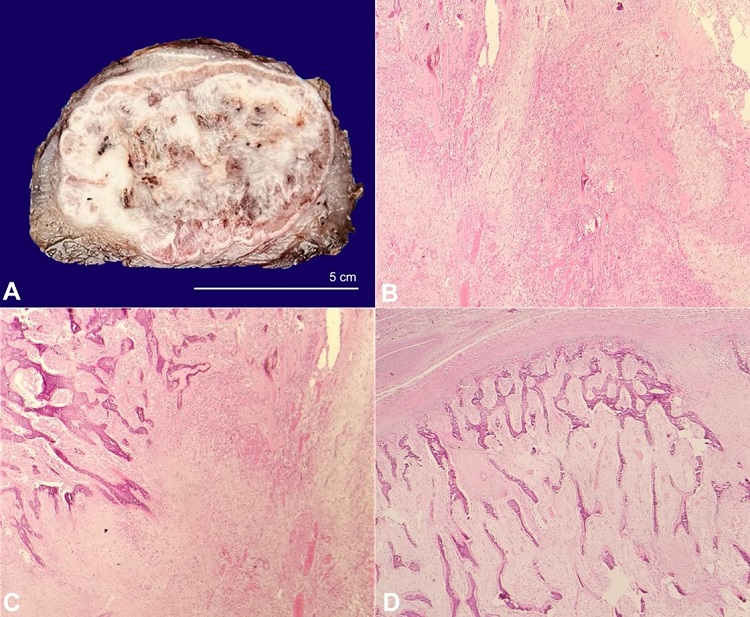 A &ndash; Gross view of the surgical specimen cut surface showing a well-circumscribed encapsulated lesion showing the pathognomonic zonation. B, C and D &ndash; Hematoxylin and Eosin-stained photomicrographs (40x magnification) of the tumor; B &ndash; The central zone shows hypocellular and hypercellular areas of loosely textured myofibroblasts with Interspersed dilated thin-walled capillaries; C &ndash; The intermediate zone shows the transition to ossification in the form of lace-like osteoid undergoing calcification; D &ndash; The outer zone shows organization of the calcified osteoid into a compact lamellar bone, which is separated from the surrounding tissue by a thick fibrous capsule.