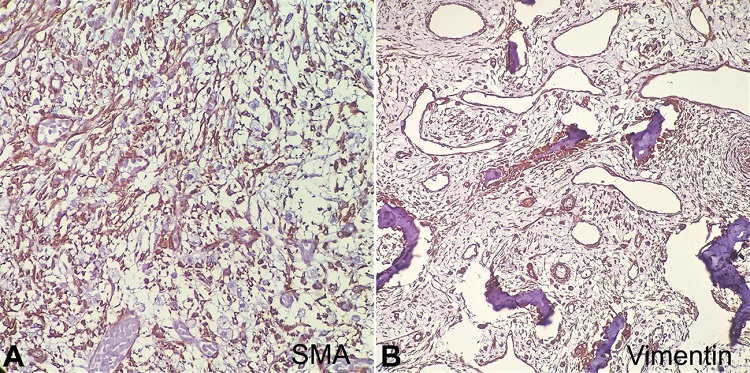 Photomicrographs (100x magnification) of the tumor. A &ndash; Smooth muscle actin (Clone EP188, Pathnsitu) highlights the myofibroblasts; B &ndash; Vimentin (Clone EP21, Pathnsitu) highlights the osteoblastic rimming of the bony trabeculae.