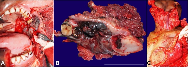A &ndash; Intraoperative view showing wide local excision of the tumor along with left segmental mandibulectomy and infrastructural maxillectomy; B &ndash; Surgical specimen after the excision of the tumor; C &ndash; Harvation of the pectoralis major myocutaneous flap (left side) for soft tissue reconstruction.