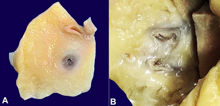 Gross view of the coronary arteries’ cut section. A – right coronary artery showing thickened wall and luminal narrowing; B – Gross image of left anterior descending coronary artery showing thickened gelatinous wall and partial obliteration of the lumen.