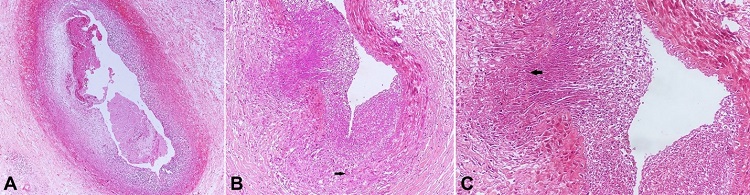 Photomicrographs of the coronary artery. A – right coronary showing non-occlusive fibrin thrombus and fibrointimal thickening with dense lymphohistiocytic infiltrate (H&E x 200); B – LAD showing luminal narrowing and dense transmural lymphohistiocytic infiltrate with occasional Langhans giant cell (arrow) (H&E x 100); C – Higher magnification of inflamed LAD to highlight focal necrosis and destruction of the elastic lamina (arrow) (H&E x 200).
