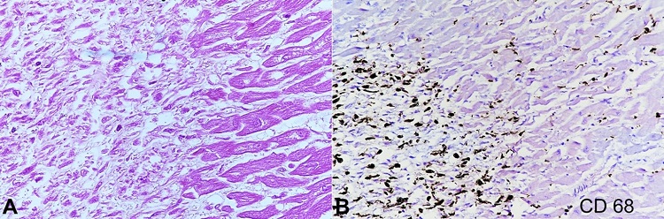 Photomicrograph of the myocardium. A – Patchy infiltrate of histiocytes within myocardial fibers (H&E, x 400); B – CD 68 positive infiltrate of histiocytes within myocardial fibers (X 200).