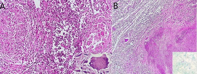 Photomicrograph of the lymph node. A – Epithelioid cell granulomas in the lymph node (Inset- multinucleated giant cell) (H&E x 200); B – Extensive caseous necrosis in paratracheal lymph node (H&E x 100). Acid-fast bacilli (Inset ZN x 1000).