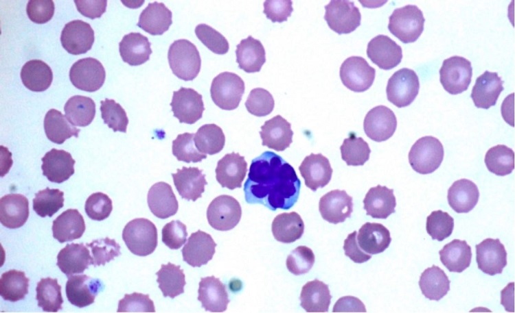 Atypical lymphocytes in peripheral blood smear surrounded by RBC (echinocytes) with small thorny projections. (Original Magnification x1000).