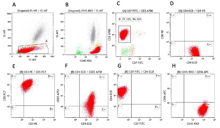 Flow cytometry analysis on peripheral blood lymphocytes. The atypical lymphocytes were detected by blood flow cytometry, gated and painted in red color. A. shows side scatter (SS) versus forward scatter (FS); B. The atypical cells are strongly expressing CD45, C. The atypical cells are expressing CD2, but not CD7, D. The atypical cells are CD4 positive but CD8 negative, E. The majority of atypical cells are expressing CD3 and CD5. F. The atypical cells are expressing CD4 while CD25 Is partially expressed. G. The CD4 positive atypical T-cells are negative for CD7. H. The atypical cells are negative for CD56. 