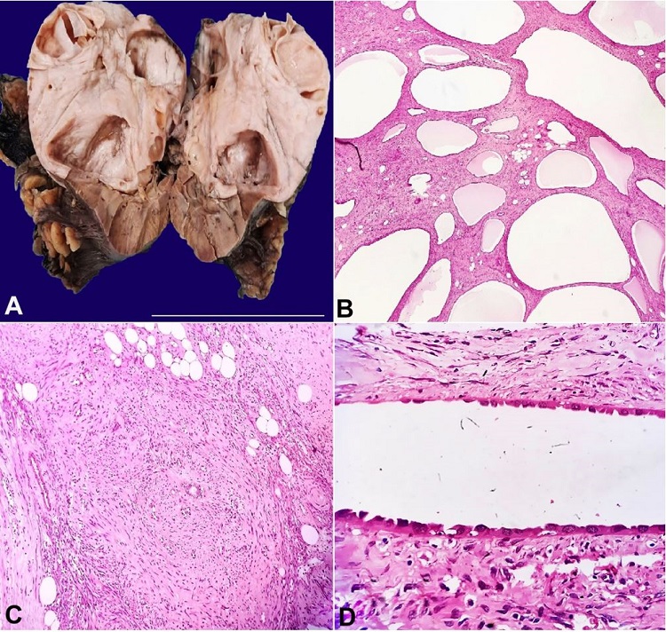 A &ndash; Gross view of the surgical specimen showing large solid grey white mass with entrapped cystic spaces; B &ndash; Photomicrograph showing multiple variable sized cystic spaces (H&E, 40X); C &ndash; Photomicrograph showing hypercellular stroma along with adipocytic aggregates (H&E, 40X); D &ndash; Photomicrograph showing epithelial cysts lined by cuboidal to hobnailed cells (H&E400X).
