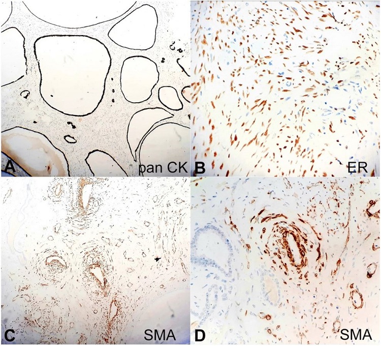 Photomicrographs of the tumor. A &ndash; Epithelium lining the cystic spaces showing intense pancytokeratin staining (100X); B &ndash; Compact ovarian like stroma showing nuclear ER staining (400X); C &ndash; Vessel walls and few stromal cells highlighted by SMA (100X); D &ndash; SMA highlighting blood vessel (400X).