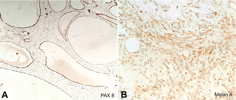 Photomicrographs of the tumor. A &ndash; Epithelium lining the cystic spaces expressing PAX-8 (100X); B &ndash; Stromal cells showing diffuse positivity for Melan A (400X).