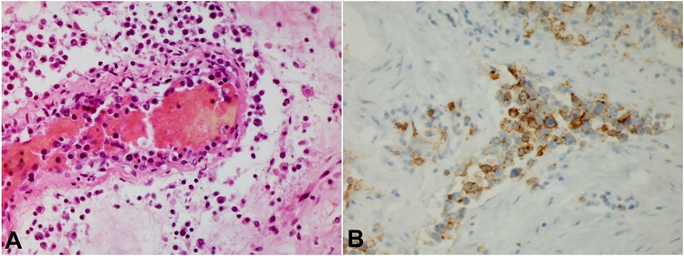 A – Medium sized blood vessel, Kidney (H&E, 440x); B – CD20 immunostaining, Kidney (440x) demonstrating malignant lymphoid infiltrate which stains positive for CD20.