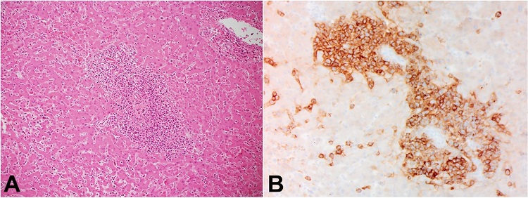 A – Liver with lymphocytic infiltrate (H&E, 440x); B – CD20 immunostaining, Liver (440x) demonstrating malignant lymphoid infiltrate which stains positive for CD20.