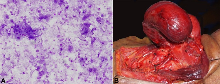 A – Fine needle aspiration smear showing sheets of anucleated squames admixed with few nucleated squamous cells without any nuclear atypia (Leishman stain; 200x); B – Intraoperative photograph showing complete removal of the tumor with preservation of the neurovascular structures.