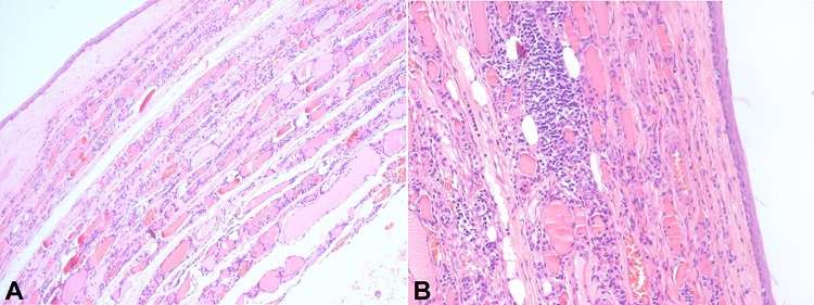 A – Photomicrograph of the surgical specimen showing a cyst wall lined by benign squamous epithelium with rim of compressed benign thyroid parenchyma (H&E; 100x); B – Focally the cyst wall shows moderate infiltration of lymphocytes with formation of lymphoid aggregate in the adjacent surrounding thyroid parenchyma (H&E; 200x).