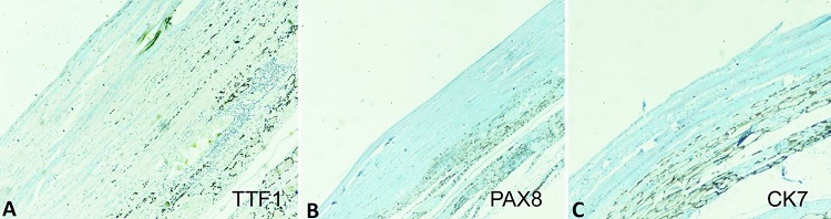 Photographs showing the negative reaction for A – TTF1; B – PAX8; C – CK7.
