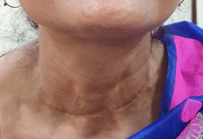 Follow up photograph (3 months) with healed scar and without evidences of recurrence.