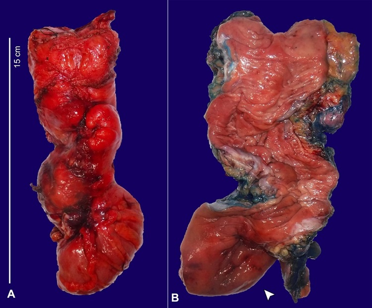 Gross examination of the resected colon. A – Segment of rectum measuring 15 cm in length and approximately 4.5 cm in average diameter with mucosa demonstrating diffuse necrosis; B – Area of dilatation identified at the distal end of the resected rectum measuring up to 7 cm in average diameter (arrowhead).