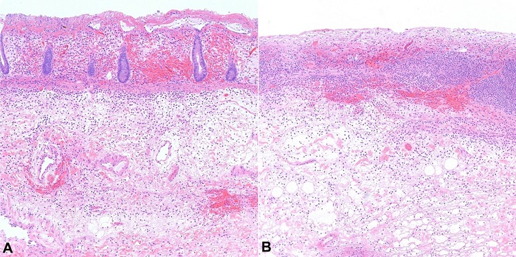 Microscopic examination showing areas of extensive necrosis (H&E stain). A – Histopathologic examination of the resected colon demonstrated extensive, nearly transmural necrosis; B – with moderate to severe acute and chronic inflammation. Microscopic images were examined at 100x.