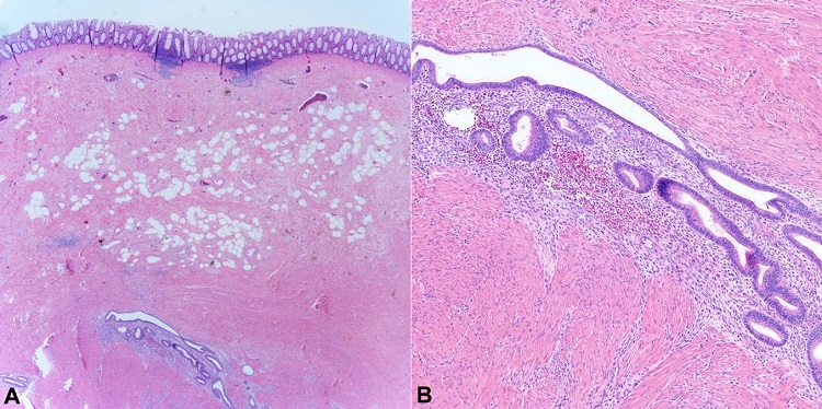Microscopic examination showing areas of intestinal endometriosis (H&E stain). Histopathologic examination demonstrating colonic mucosa with endometrial glandular epithelium (black arrow) and endometrial stroma (red arrow) within the submucosa and muscularis propria. Microscopic images were examined at A – 25x; and B – 100x, respectively.