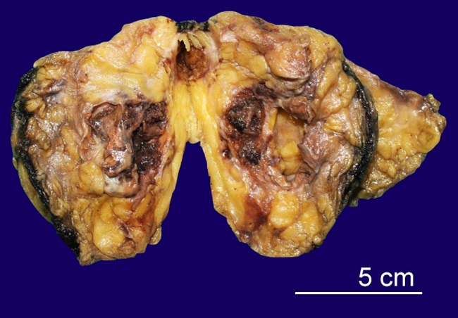 Gross view of the tumor showing multiloculated solid-cystic mass filled with blood.