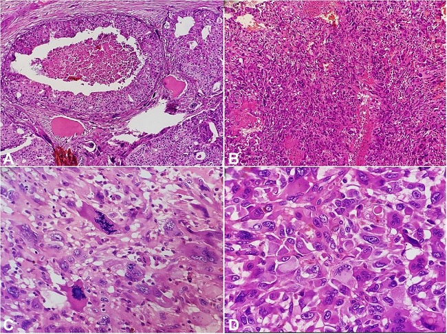 Photomicrograph of the tumor. A &ndash; Epithelial component, ductal carcinoma in situ with comedonecrosis and cribriform pattern (H&E, &times;100); B &ndash; Malignant stromal component in vague fascicles of spindle cells (H&E, &times;100); C &ndash; Tumor cells with marked nuclear pleomorphism and atypical mitotic figures (H&E, &times;400); D &ndash; Malignant ovoid to spindle shaped cells (H&E, &times;400).