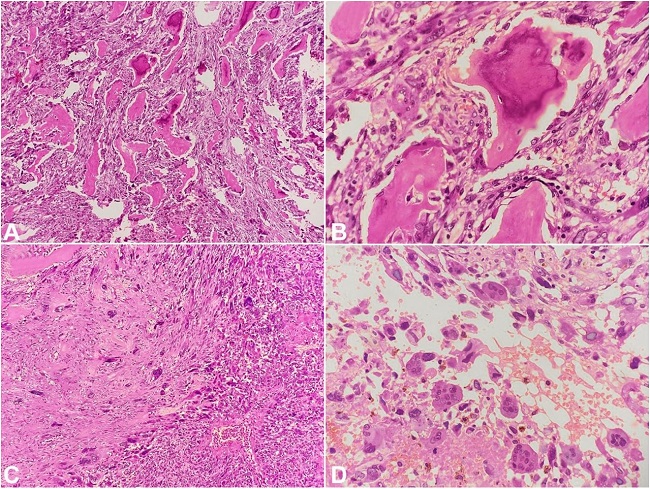 Photomicrograph of the tumor. A &ndash; Metaplastic breast carcinoma with abundant osteoid formation (H&E, &times;100); B &ndash; High power view showing osseous differentiation (H&E, &times;400); C &ndash; Vague fascicles of spindle cells with numerous tumor giant cells (H&E, &times;100); D &ndash; Numerous osteoclastic giant cells interspersed with malignant cells (H&E, &times;400).