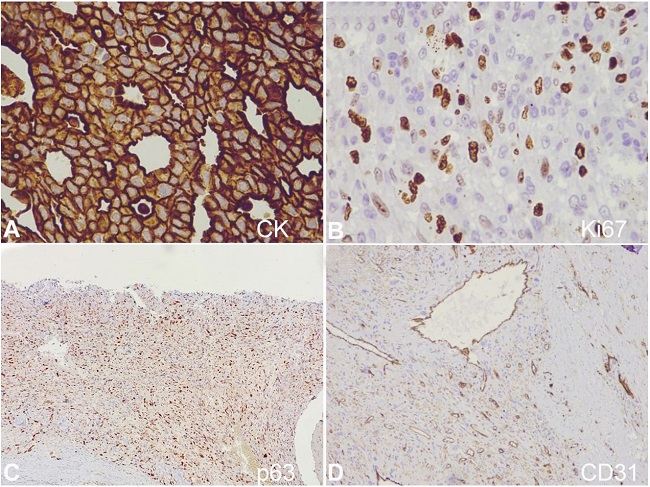 Photomicrograph of the tumor. A &ndash; CK Epithelial component showing diffuse membranous and cytoplasmic immunoreactivity for cytokeratin (IHC, &times;400); B &ndash; Ki67 proliferation index around 8-10% (IHC, &times;400); C &ndash; p63 positive in mesenchymal component (IHC, &times;100); D &ndash; CD31 highlighting the proliferating vessels between tumor cells (IHC, &times;100).